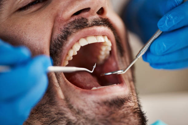 Best Knocked-Out Tooth (Avulsed Tooth) Treatment in Palm Desert, CA