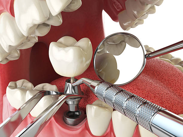 Best Emergency Root Canal Therapy in Palm Desert, CA